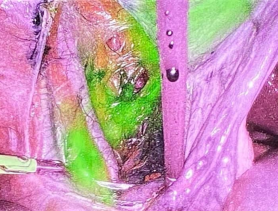 ΠΡΩΤΟΠΟΡΙΑΚΗ ΤΕΧΝΙΚΗ ΤΟΥ ΦΡΟΥΡΟΥ ΛΕΜΦΑΔΕΝΑ ΣΤΗΝ ΛΑΠΑΡΟΣΚΟΠΙΚΗ ΑΝΤΙΜΕΤΩΠΙΣΗ ΤΟΥ ΚΑΡΚΙΝΟΥ ΤΟΥ ΕΝΔΟΜΗΤΡΙΟΥ