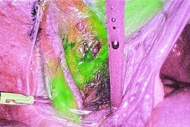 ΠΡΩΤΟΠΟΡΙΑΚΗ ΤΕΧΝΙΚΗ ΤΟΥ ΦΡΟΥΡΟΥ ΛΕΜΦΑΔΕΝΑ ΣΤΗΝ ΛΑΠΑΡΟΣΚΟΠΙΚΗ ΑΝΤΙΜΕΤΩΠΙΣΗ ΤΟΥ ΚΑΡΚΙΝΟΥ ΤΟΥ ΕΝΔΟΜΗΤΡΙΟΥ